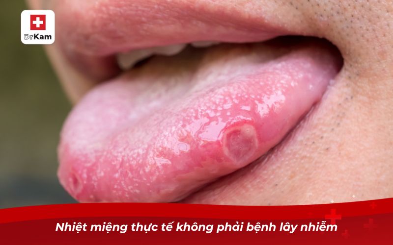 Nhiệt miệng có lây không? Sự thật ai cũng nên biết 7 Nhiệt miệng thực tế không phải bệnh lây nhiễm