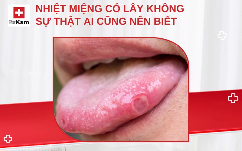 nhiet mieng co lay khong thumbnail