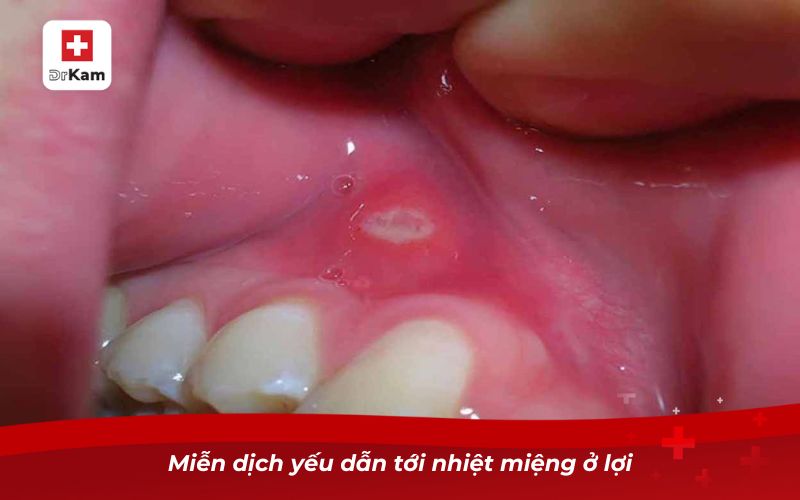 Nhiệt miệng ở lợi - Hiểu đúng để tránh sai lầm khi điều trị 7 Miễn dịch yếu dẫn tới nhiệt miệng ở lợi