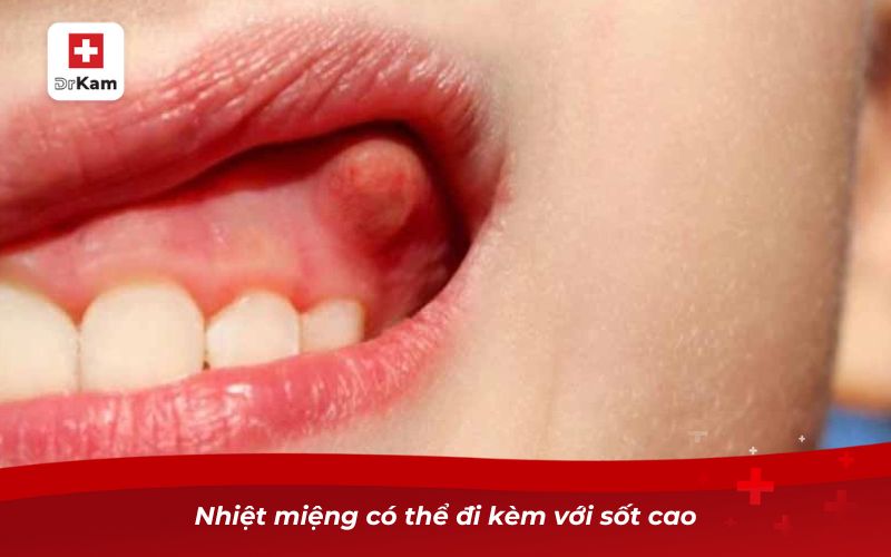 Nhiệt miệng ở lợi - Hiểu đúng để tránh sai lầm khi điều trị 8 Nhiệt miệng có thể đi kèm với sốt cao