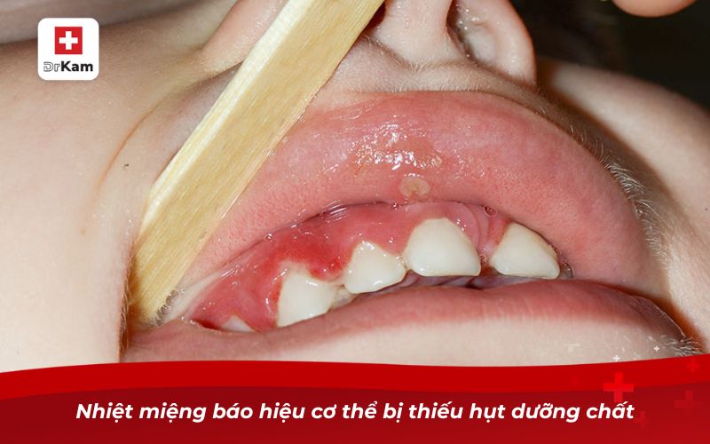 Nhiệt miệng ở lợi - Hiểu đúng để tránh sai lầm khi điều trị 9 Nhiệt miệng báo hiệu cơ thể bị thiếu hụt dưỡng chất