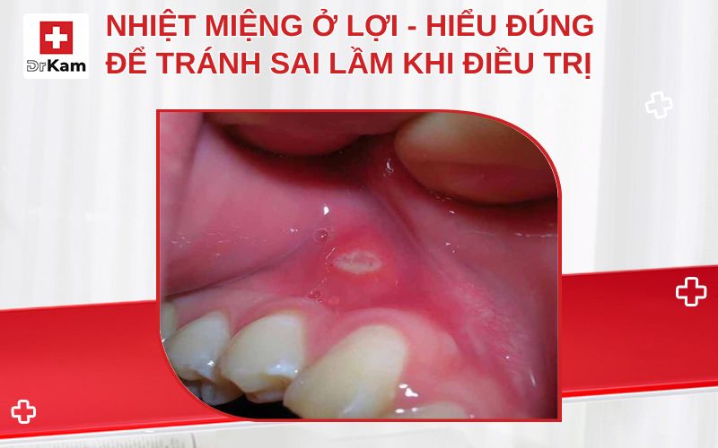 nhiet mieng o loi thumbnail