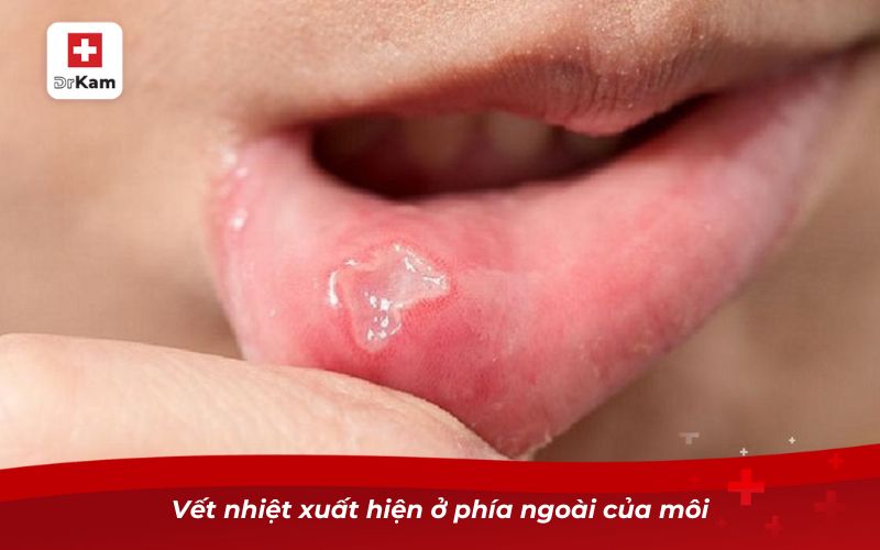 Nhiệt miệng ở môi ngoài có nguy hiểm không? 7 Vết nhiệt xuất hiện ở phía ngoài của môi