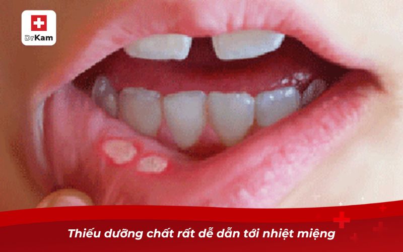 Nhiệt miệng ở môi ngoài có nguy hiểm không? 8 Thiếu dưỡng chất rất dễ dẫn tới nhiệt miệng