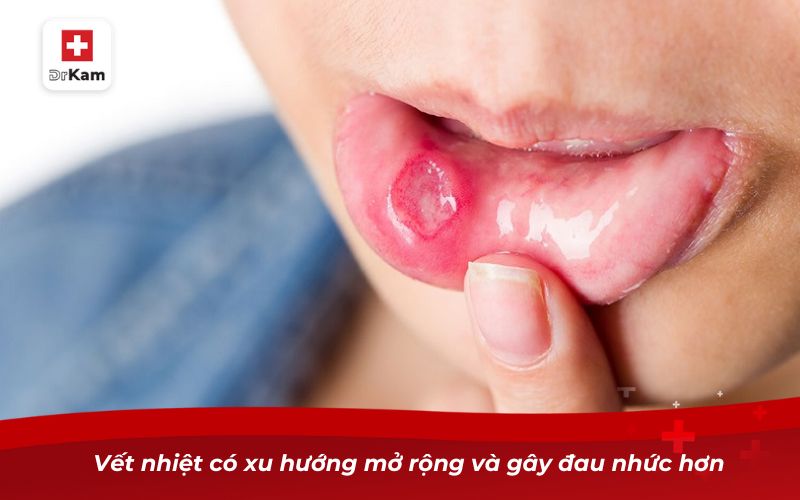 Nhiệt miệng ở môi ngoài có nguy hiểm không? 10 Vết nhiệt có xu hướng mở rộng và gây đau nhức hơn