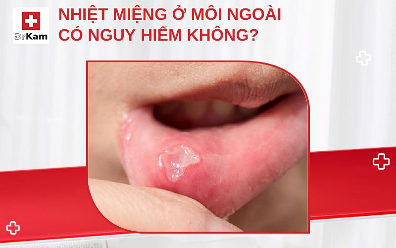 nhiet mieng o moi ngoai thumbnail