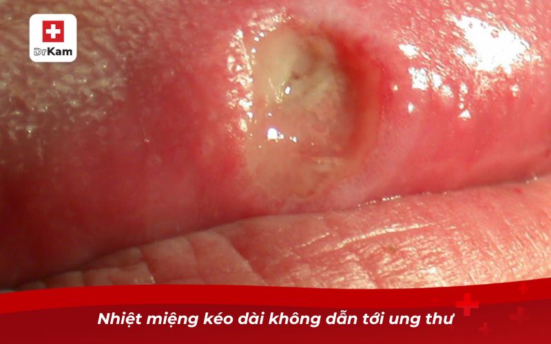 Ung thư nhiệt miệng có phải là một căn bệnh không? 7 Nhiệt miệng kéo dài không dẫn tới ung thư