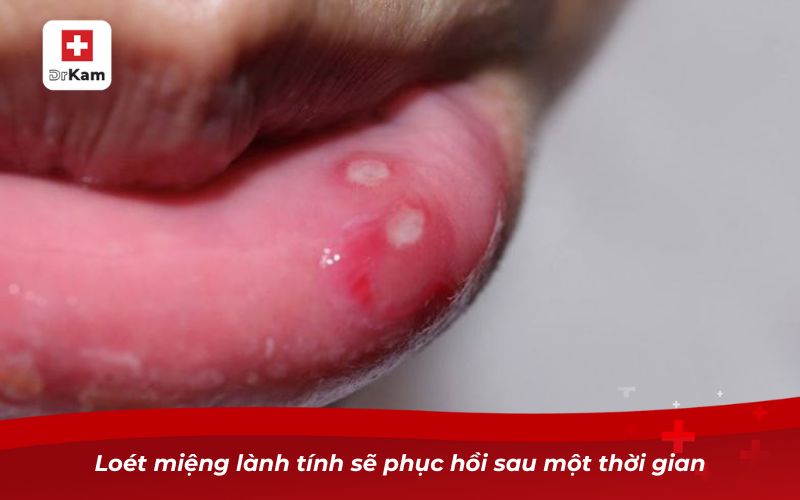 Ung thư nhiệt miệng có phải là một căn bệnh không? 8 Loét miệng lành tính sẽ phục hồi sau một thời gian