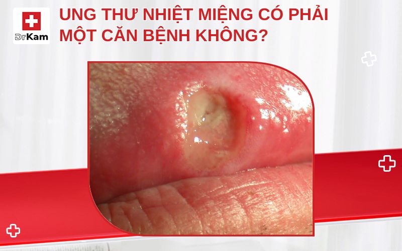 ung thu nhiet mieng thumbnail