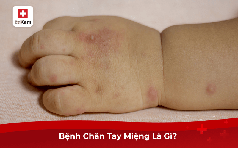 Mắc Bệnh Chân Tay Miệng Ở Trẻ Em Cần Kiêng Gì Để Nhanh Khỏi 7 Bệnh Chân Tay Miệng Là Gì?