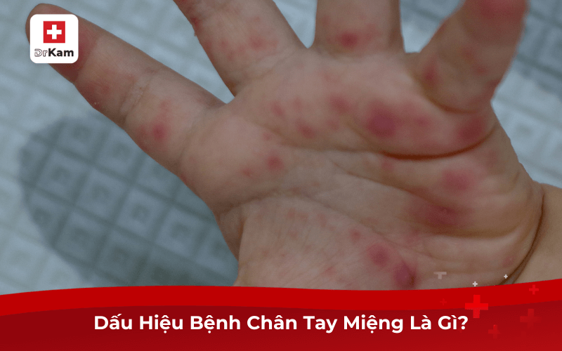Nhận Biết Dấu Hiệu Bệnh Chân Tay Miệng Để Điều Trị Kịp Thời 6 Dấu Hiệu Bệnh Chân Tay Miệng Là Gì?