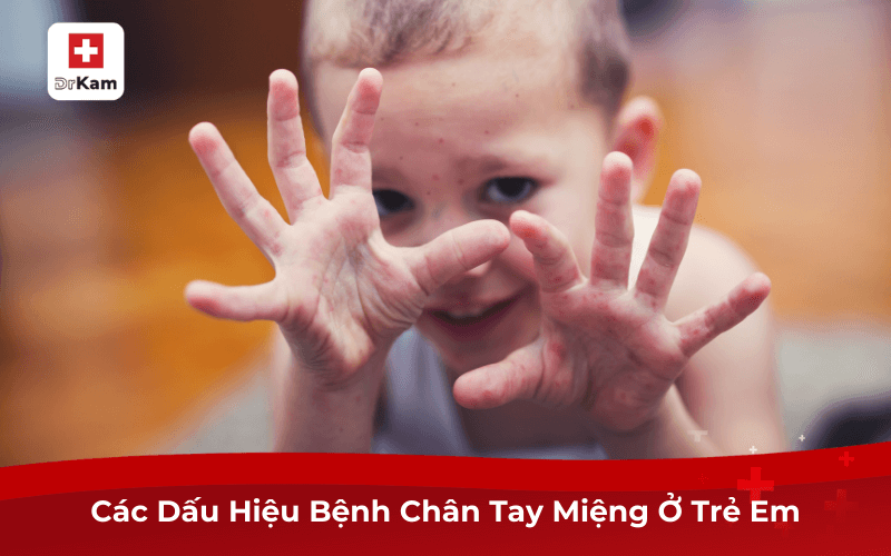 Nhận Biết Dấu Hiệu Bệnh Chân Tay Miệng Để Điều Trị Kịp Thời 7 Các Dấu Hiệu Bệnh Chân Tay Miệng Ở Trẻ Em