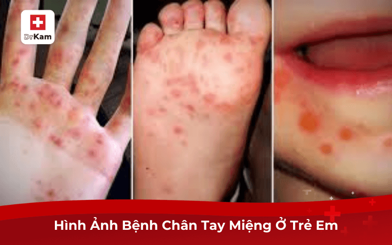 Nhận Biết Dấu Hiệu Bệnh Chân Tay Miệng Để Điều Trị Kịp Thời 8 Hình Ảnh Bệnh Chân Tay Miệng Ở Trẻ Em