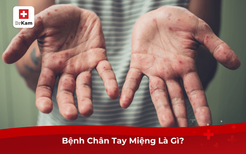 Giải Đáp: Bệnh Chân Tay Miệng Có Nguy Hiểm Không? 6 Bệnh Chân Tay Miệng Là Gì?