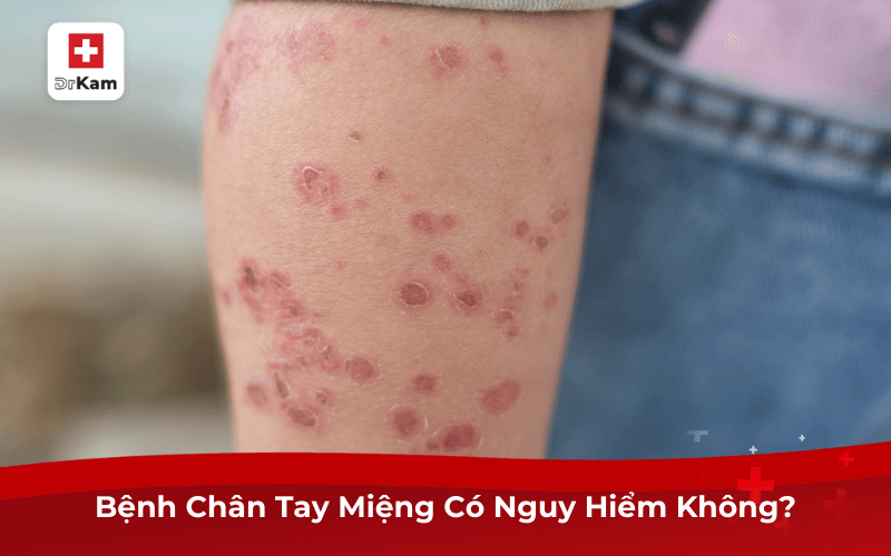 Giải Đáp: Bệnh Chân Tay Miệng Có Nguy Hiểm Không? 7 Bệnh Chân Tay Miệng Có Nguy Hiểm Không?