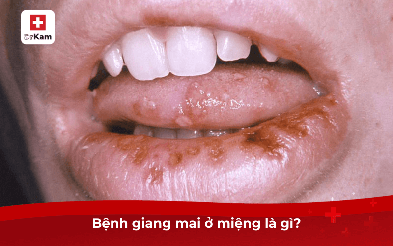 Biểu hiện bệnh giang mai ở miệng? Cách giảm triệu chứng 6 Bệnh giang mai ở miệng là gì?