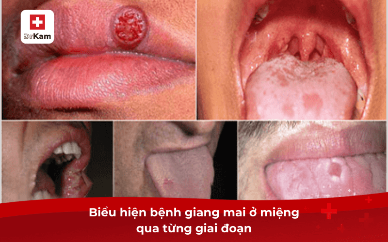 Biểu hiện bệnh giang mai ở miệng? Cách giảm triệu chứng 7 Biểu hiện bệnh giang mai ở miệng qua từng giai đoạn