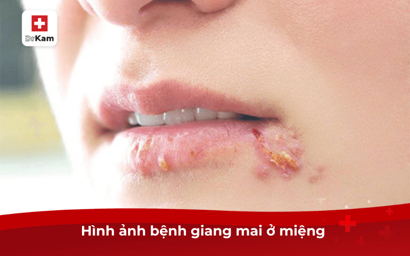 Biểu hiện bệnh giang mai ở miệng? Cách giảm triệu chứng 8 Hình ảnh bệnh giang mai ở miệng
