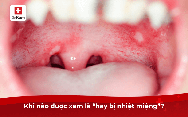 Hay bị nhiệt miệng là dấu hiệu của bệnh gì? Nguy hiểm không? 6 Khi nào được xem là “hay bị nhiệt miệng”?