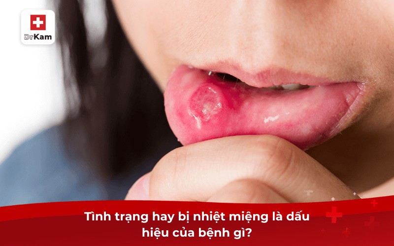 Hay bị nhiệt miệng là dấu hiệu của bệnh gì? Nguy hiểm không? 8 Tình trạng hay bị nhiệt miệng là dấu hiệu của bệnh gì?