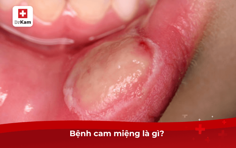 Bệnh cam miệng là gì?