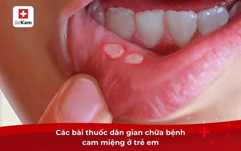 Các bài thuốc dân gian chữa bệnh cam miệng ở trẻ em