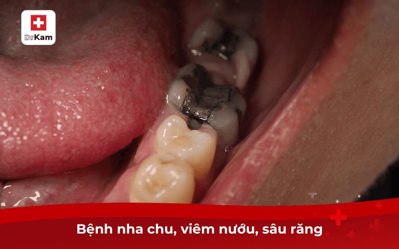 Bị hôi miệng là bệnh gì? Nguyên nhân và cách điều trị tại nhà 7 Bệnh nha chu, viêm nướu, sâu răng