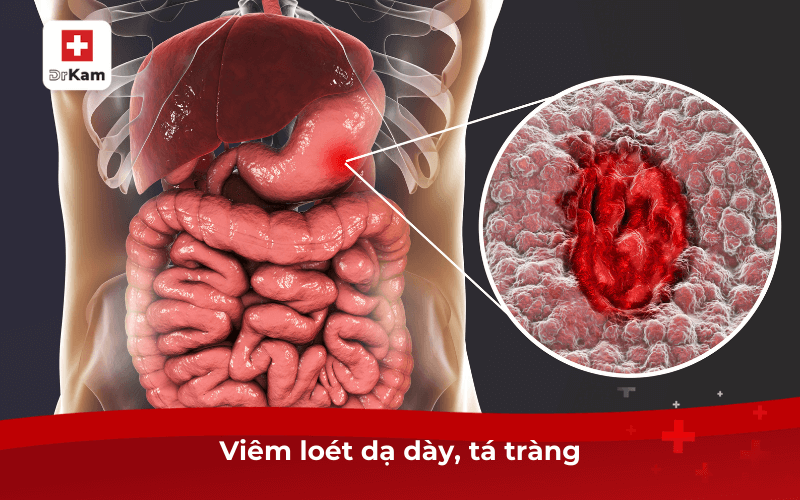 Chua miệng là bệnh gì? Nguyên nhân và cách điều trị 7 Viêm loét dạ dày, tá tràng