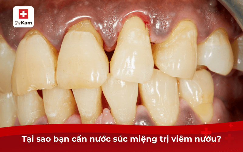 Hướng dẫn cách chọn nước súc miệng trị viêm nướu hiệu quả 7 Tại sao bạn cần nước súc miệng trị viêm nướu?