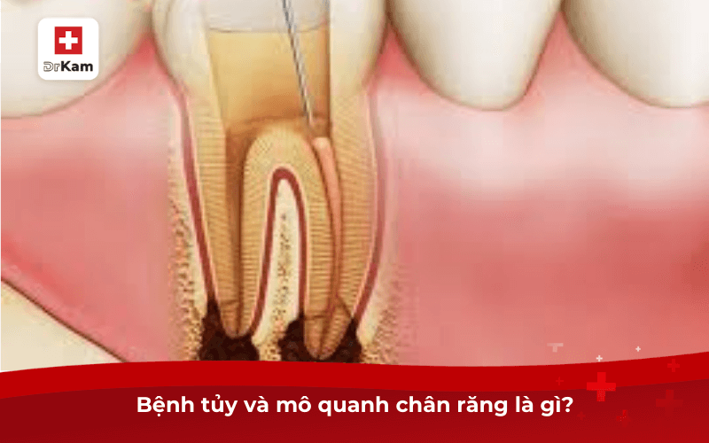 Bệnh tủy và mô quanh chân răng là gì? Có nguy hiểm không? 6 Bệnh tủy và mô quanh chân răng là gì?
