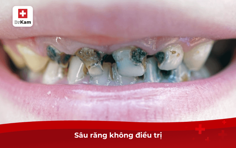 Bệnh tủy và mô quanh chân răng là gì? Có nguy hiểm không? 7 Sâu răng không điều trị