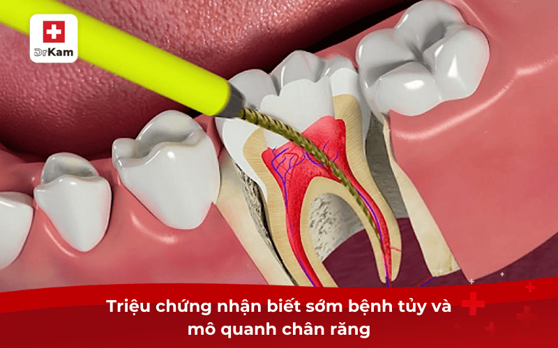 Bệnh tủy và mô quanh chân răng là gì? Có nguy hiểm không? 8 Triệu chứng nhận biết sớm bệnh tủy và mô quanh chân răng