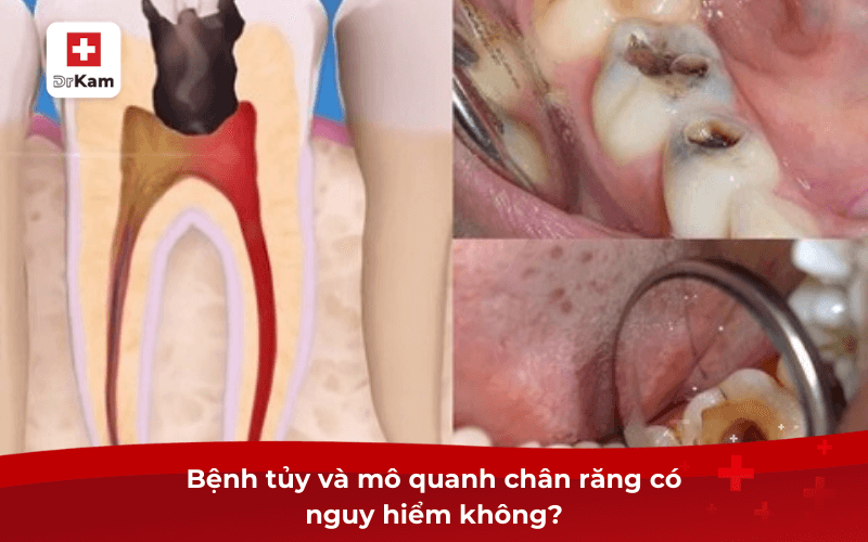 Bệnh tủy và mô quanh chân răng là gì? Có nguy hiểm không? 9 Bệnh tủy và mô quanh chân răng có nguy hiểm không?
