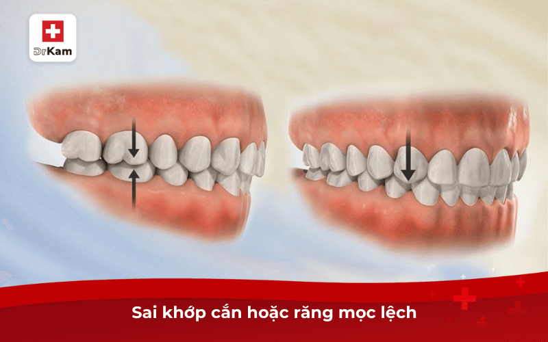 Sai khớp cắn hoặc răng mọc lệch