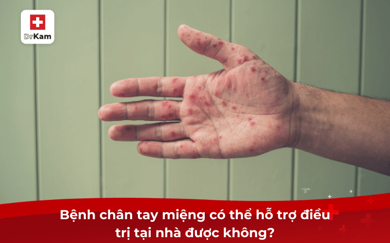 10 mẹo dân gian chữa bệnh chân tay miệng nhanh chóng 6 Bệnh chân tay miệng có thể hỗ trợ điều trị tại nhà được không?