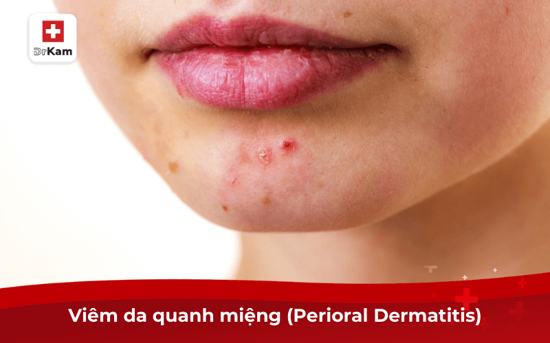 Tự nhiên mụn mọc quanh miệng là dấu hiệu của bệnh gì 7 Viêm da quanh miệng (Perioral Dermatitis)