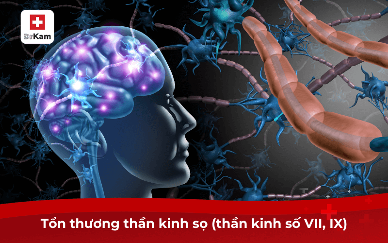 Tổn thương thần kinh sọ (thần kinh số VII, IX)