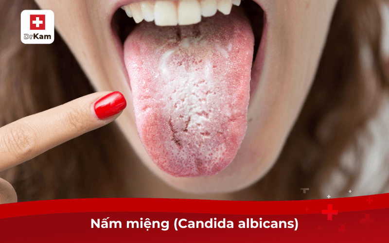 Thường xuyên ngứa trong miệng là bệnh gì? Chữa thế nào? 7 Nấm miệng (Candida albicans)