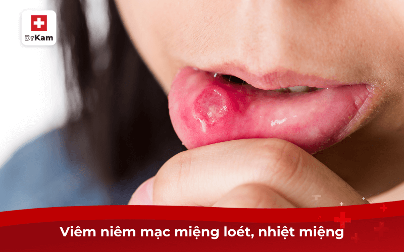 Thường xuyên ngứa trong miệng là bệnh gì? Chữa thế nào? 9 Viêm niêm mạc miệng loét, nhiệt miệng: