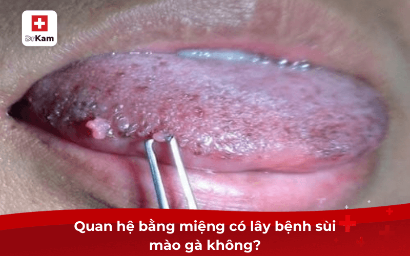 Quan hệ bằng miệng có lây bệnh sùi mào gà không? Dấu hiệu? 6 Quan hệ bằng miệng có lây bệnh sùi mào gà không?