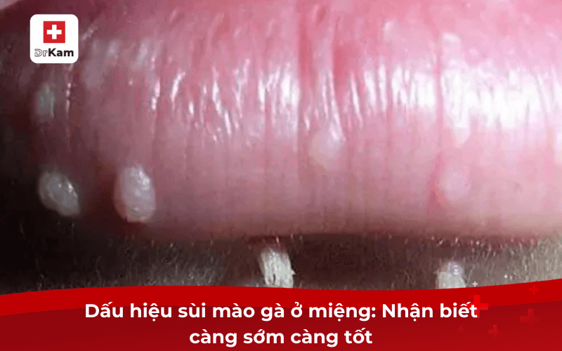 Quan hệ bằng miệng có lây bệnh sùi mào gà không? Dấu hiệu? 8 Dấu hiệu sùi mào gà ở miệng: Nhận biết càng sớm càng tốt
