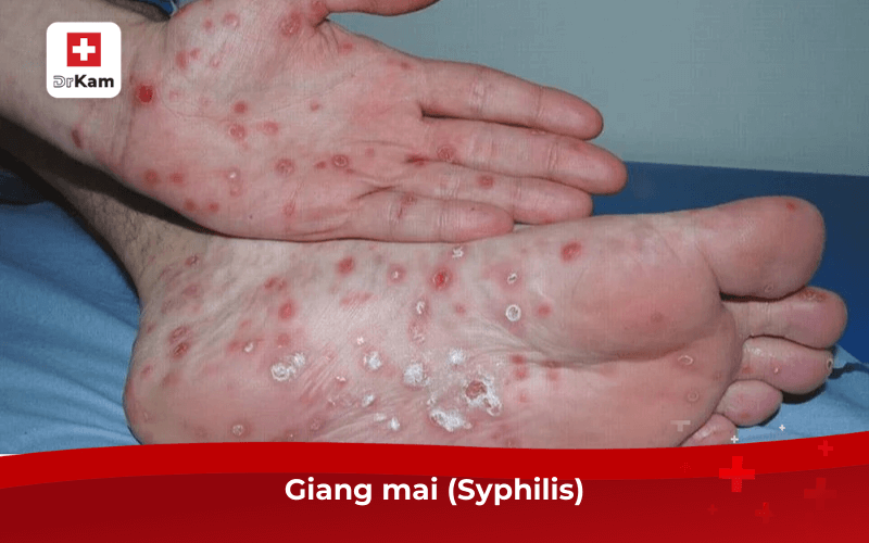 Giang mai (Syphilis)