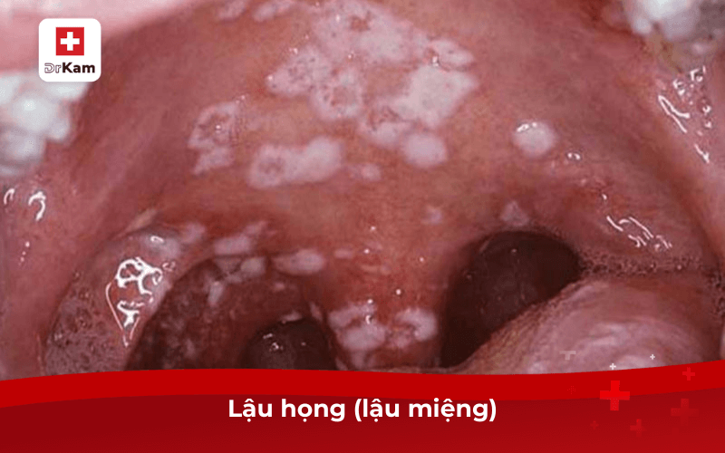 Các bệnh lây qua đường miệng khi quan hệ nguy hiểm nhất 8 Lậu họng (lậu miệng)