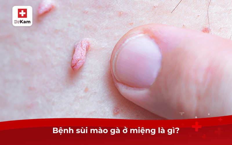 Các dấu hiệu bệnh sùi mào gà ở miệng và cách điều trị 6 Bệnh sùi mào gà ở miệng là gì?