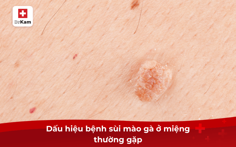 Các dấu hiệu bệnh sùi mào gà ở miệng và cách điều trị 7 Dấu hiệu bệnh sùi mào gà ở miệng thường gặp