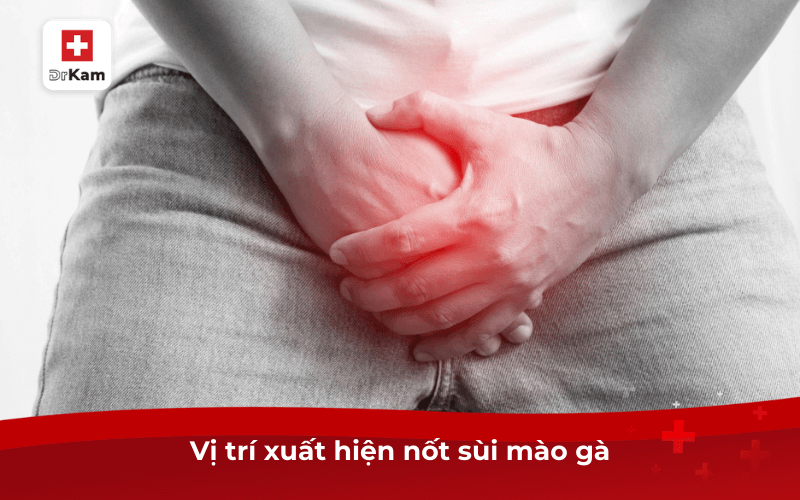 Các dấu hiệu bệnh sùi mào gà ở miệng và cách điều trị 8 Vị trí xuất hiện nốt sùi