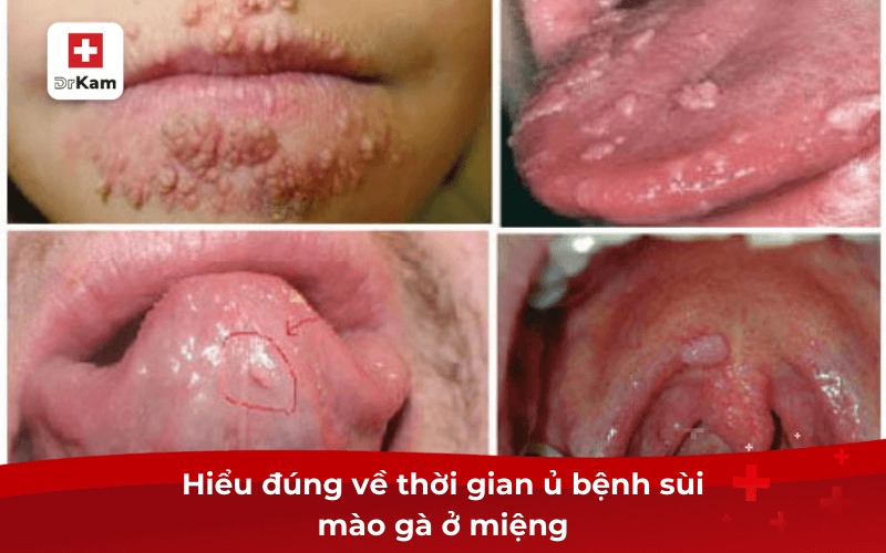Hiểu đúng về thời gian ủ bệnh sùi mào gà ở miệng