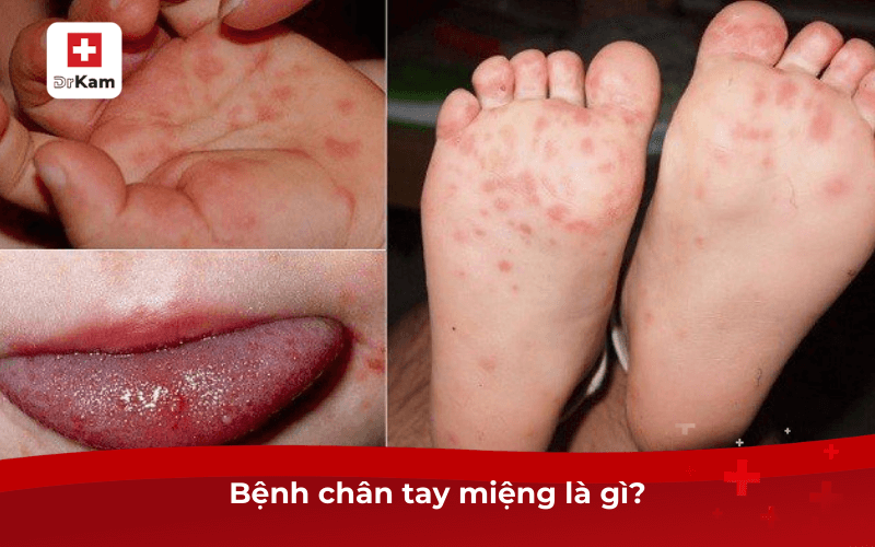 Cách chữa bệnh chân tay miệng nhanh chóng an toàn 6 Bệnh chân tay miệng là gì?
