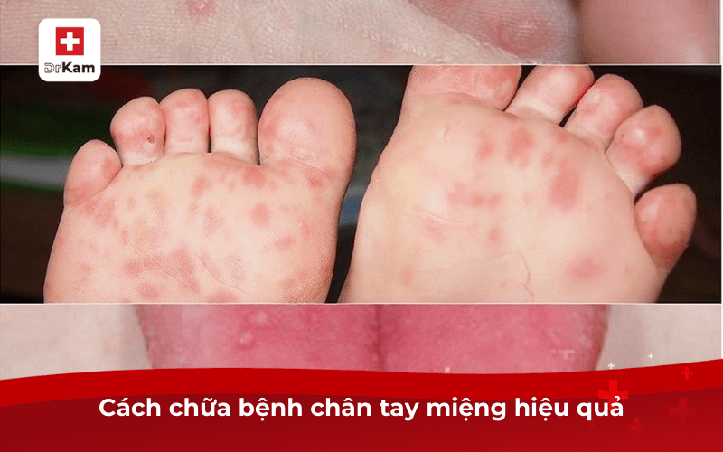 Cách chữa bệnh chân tay miệng nhanh chóng an toàn 7 Cách chữa bệnh chân tay miệng hiệu quả