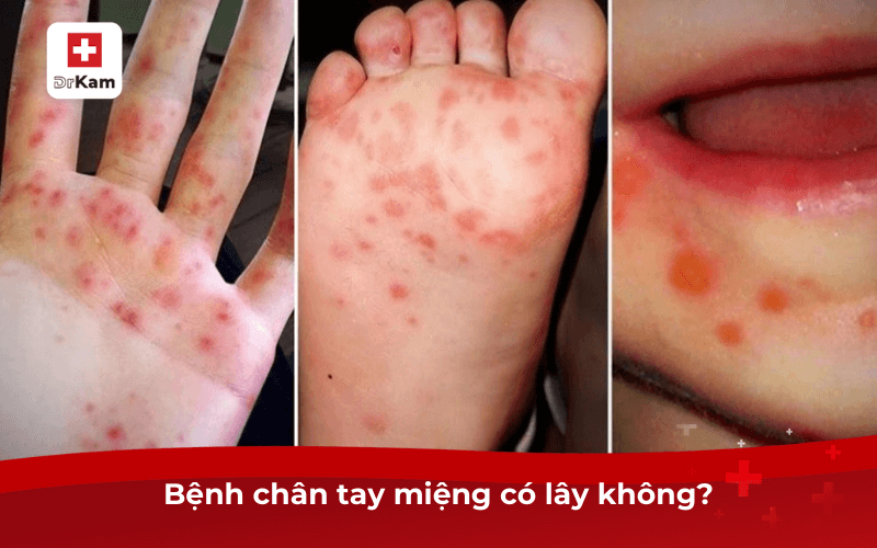 Bệnh chân tay miệng có lây không?